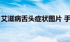 艾滋病舌头症状图片 手腕（艾滋病舌头症状）