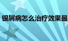 银屑病怎么治疗效果最好（银屑病怎么治疗）