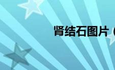 肾结石图片（结石图片）