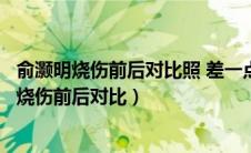俞灏明烧伤前后对比照 差一点葬送自己的演艺事业（俞灏明烧伤前后对比）