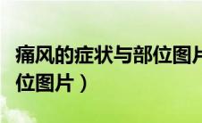 痛风的症状与部位图片对比（痛风的症状与部位图片）